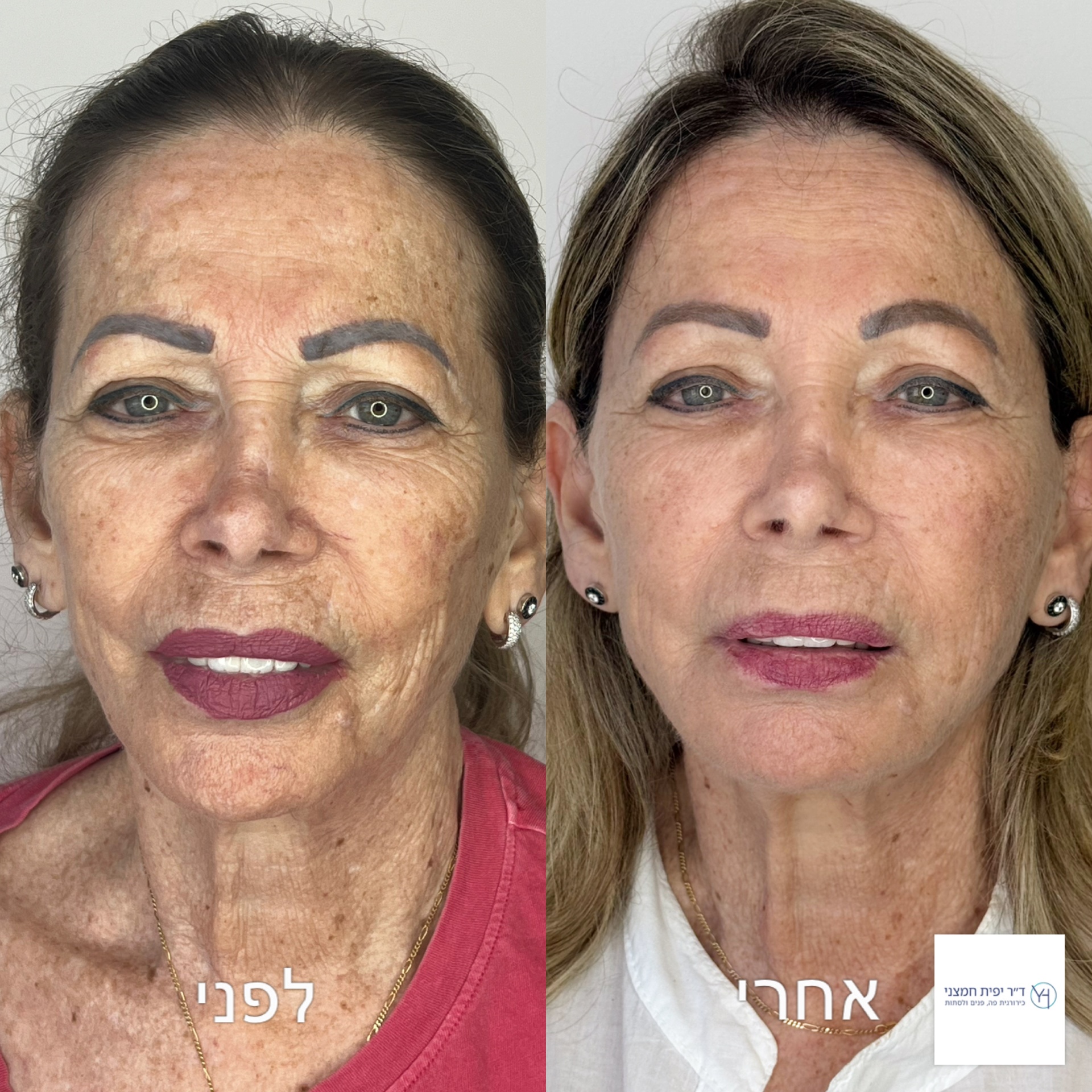 Full Face – לפני ואחרי