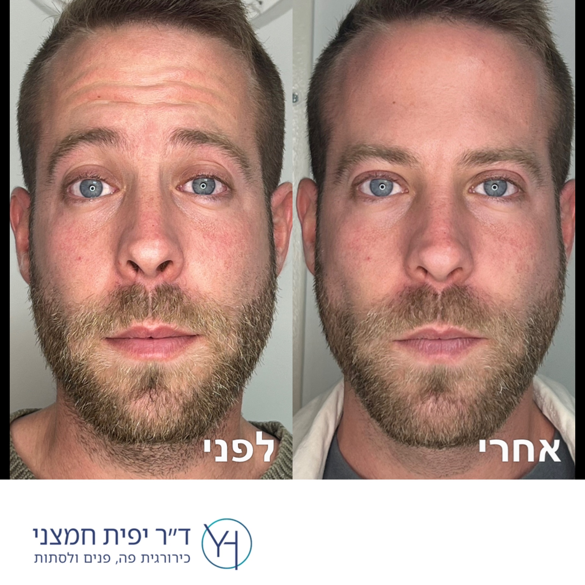 בוטוקס – לפני ואחרי