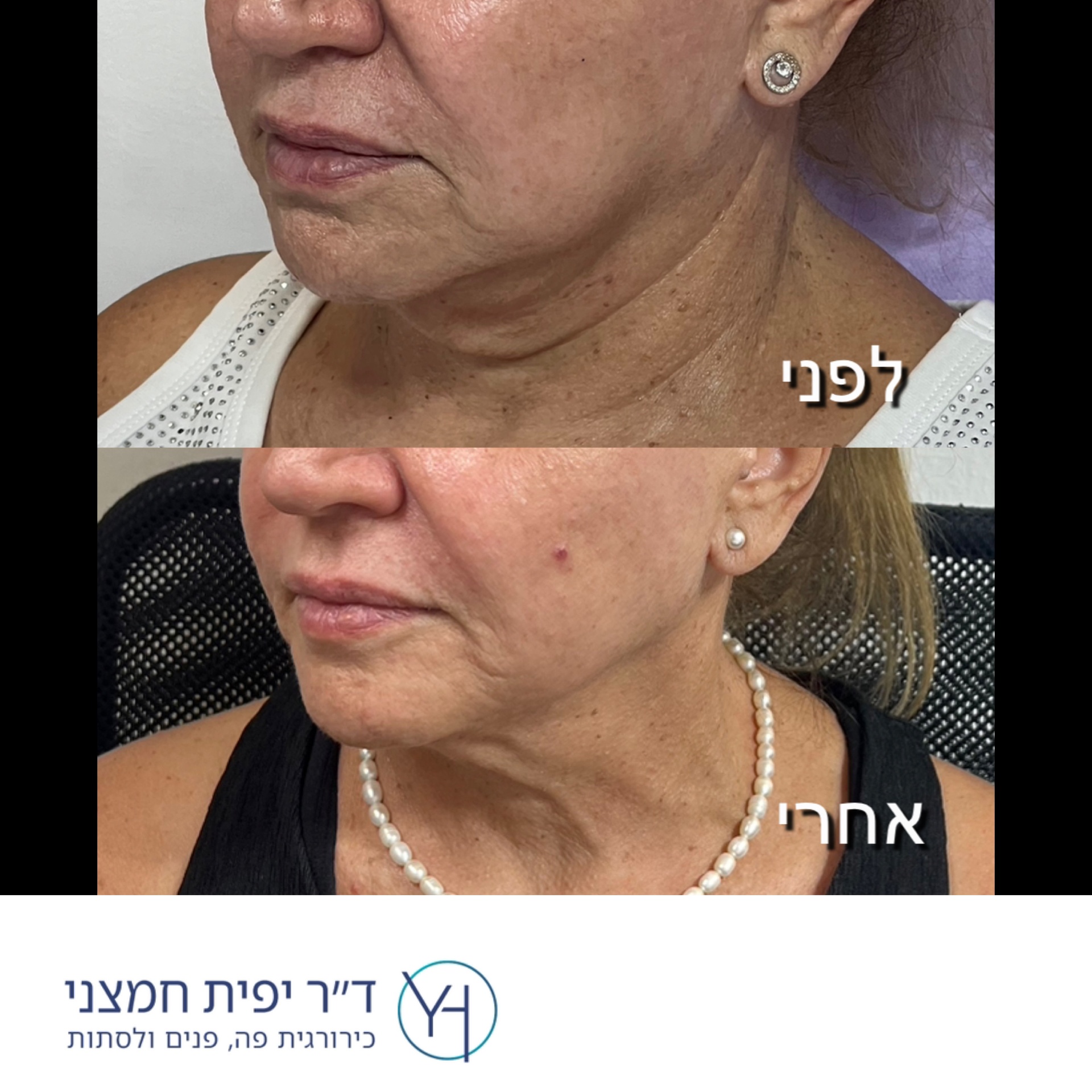 צוואר – לפני ואחרי